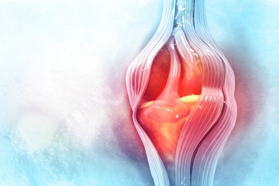 az artrózis kezelésének modern megközelítése